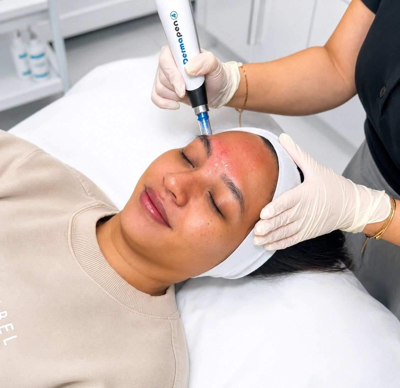 Skin Needling Facial