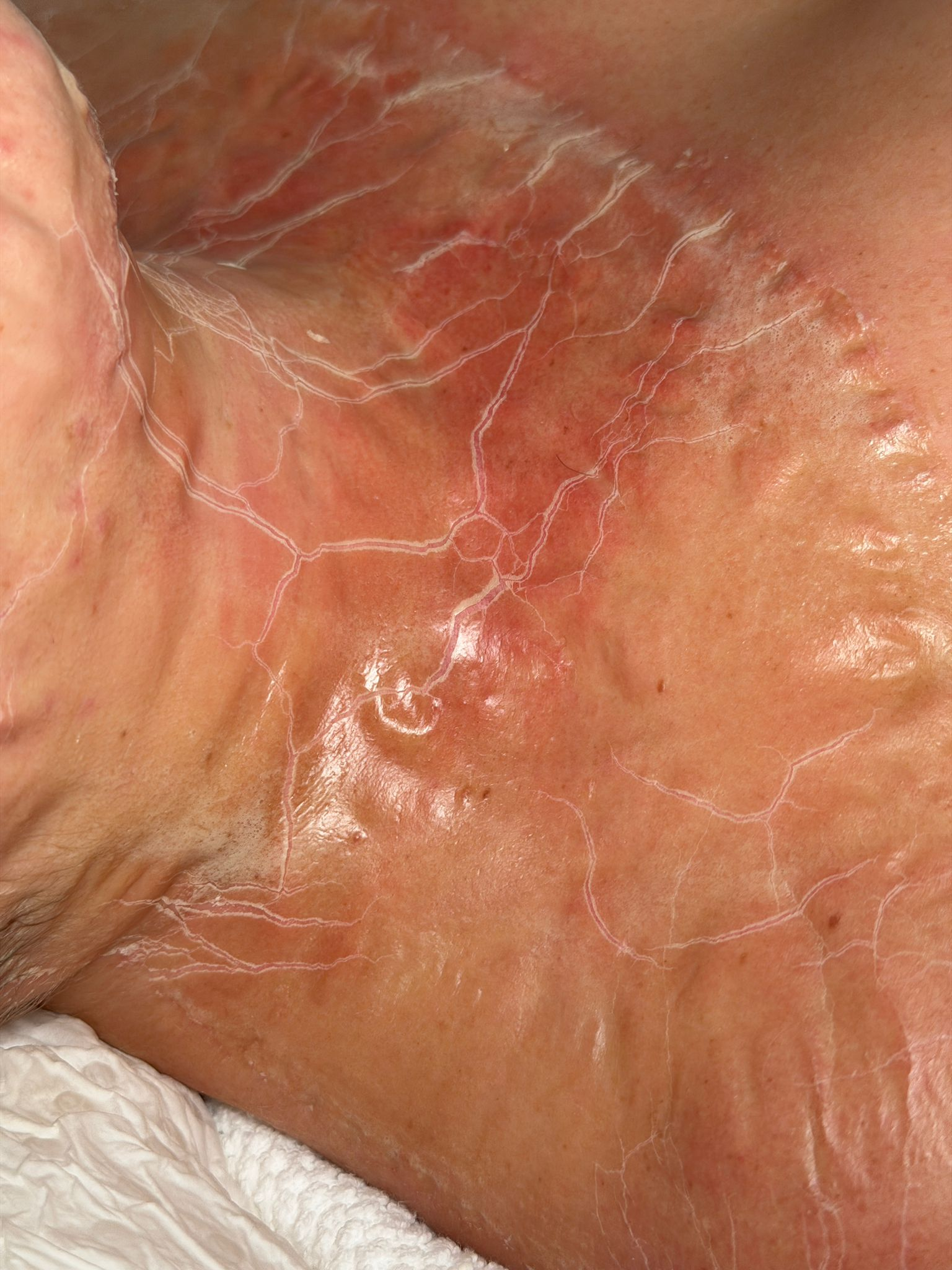 DMK Enzyme Treatment